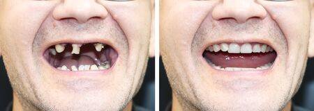 128917923-the-patient-at-the-orthodontist-before-and-after-the-installation-of-dental-implants...jpg